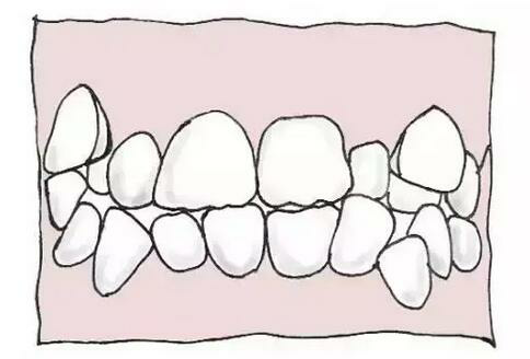 　　牙齒擁擠——笑容不自信  　　替牙期一般輕度擁擠可觀察，暫不處理;嚴重者，表現為個別或多個牙齒在各個方向的錯位，應盡快矯正。牙齒擁擠不齊影響整體美觀，會讓孩子笑容不自信。而且牙齒擁擠也妨礙局部牙齒的清潔而導致蛀牙、牙齦炎等疾病的發生。